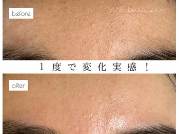ウェヌ(VENE)の写真/【市電堀川小泉駅より徒歩5分】駅近好立地で通いやすい!!希少なマツヤニwaxでお肌の汚れも産毛も一網打尽◎