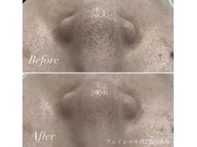 シェーン(Schon)/IPL美肌光フォト