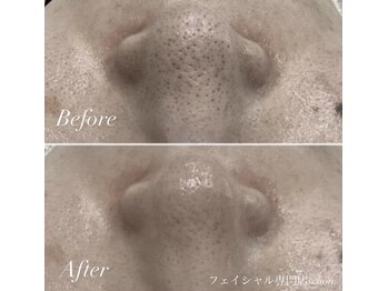 シェーン(Schon)/IPL美肌光フォト