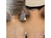 リミー(Reme)/子供脱毛専門サロンだから安心！