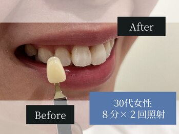 ホワイトニングカフェ 平塚店(WhiteningCafe)/◎歯のホワイトニング施術写真◎