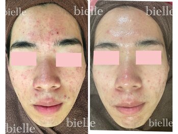 ビエル(Bielle)/2週間に1度の肌管理