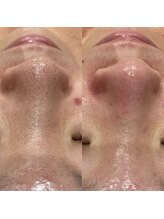 リッツ 草加店(Ritz)/【Before/After】毛穴