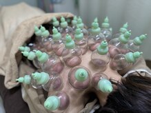 すずらん接骨院の雰囲気（人気メニュー、カッピングで肩こり、腰痛、むくみ等を解消！！）