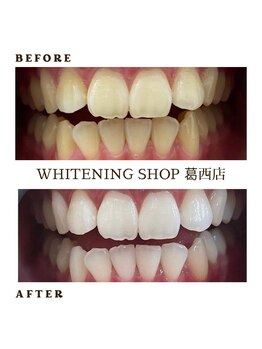 ホワイトニングショップ 葛西店/歯科提携 ホワイトニング専門店