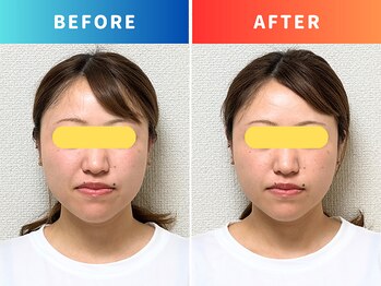 シールド バイ ココイロ(SHIELD by COCOIRO)/小顔矯正　B＆A