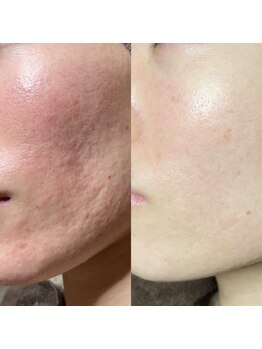 ルイース(LOUISE.)/プロセルセラピーズ肌質改善