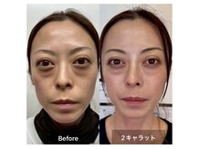 リーシャ(Reesha)/ダイヤモンドピールプログラム