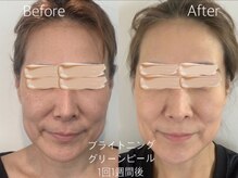 バービーフェイス 恵比寿(Barbie Face)/ブライトニングGP 1回1週間後