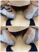 ルルトウキョウ 池袋店(LULU.tokyo)/うなじ脱毛