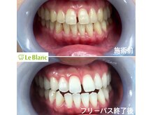 ルブラン 奈良店(Le Blanc)/黄ばみを取って