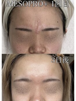 ラ ミュエル(La miel)/72時間集中ケア　