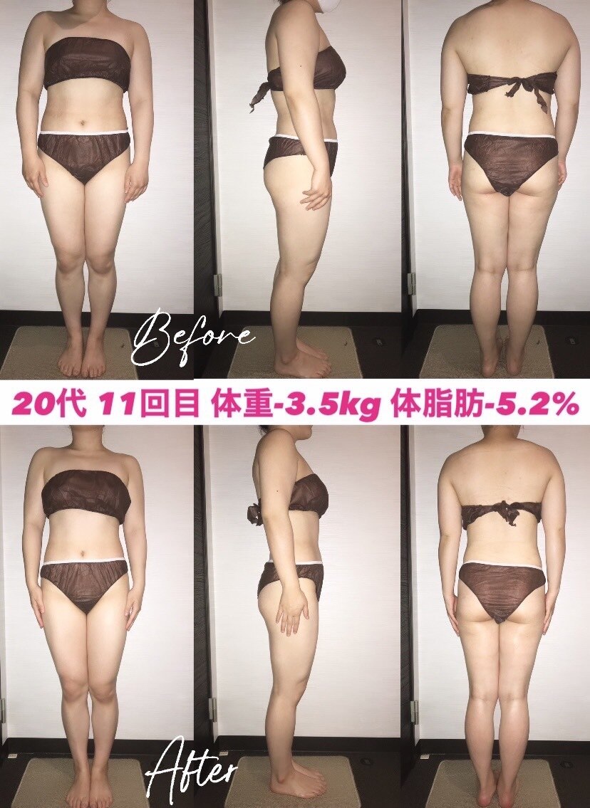 シェイプリフト　定価約30万　美容　痩身　ダイエット ボブリフト.プレミアム / シルエットソフト（Silhouette Soft