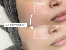 アンシャンテ 神戸元町店(Enchante)/毛穴洗浄ピーリングフェイシャル