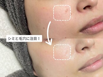 アンシャンテ 神戸元町店(Enchante)/毛穴洗浄ピーリングフェイシャル