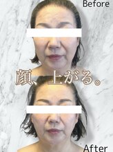 ルミライ(Lumirai)/たるみ改善|毛穴|フェイシャル