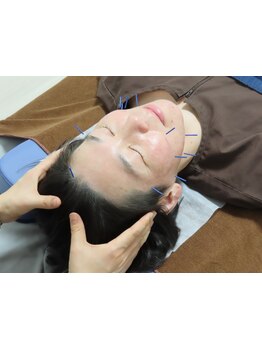 鍼灸施術を受けたい