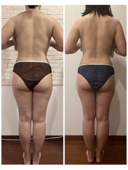 うつくし痩身 美サロン ゼットワン(Z-ONE)/筋膜リリースメディセル9回