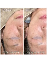 アンドナップ(nap)/マイナス５歳肌