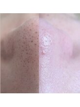 ホワイトニングショップ 町田店/【毛穴悩み】韓国式3D毛穴洗浄