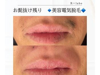 アールプラスラボ(R+labo)/美容電気脱毛のこれがすごい！