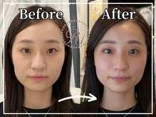 R-1ビューティーサロン 銀座/BEFORE＆AFTER　３回目