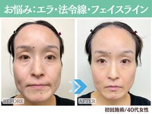 ナチュラルビューティーフェイス 横浜(NBF)/エラ・ほうれい線など / 40代