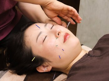 江東整体院/美容鍼で顔のむくみをスッキリ♪