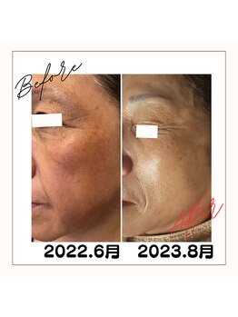 リマイン(Re mine)/肌の引き締め/細胞を活性化