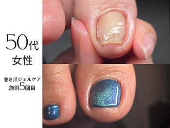フットケア クラッシー(footcare classy)/ジェルで巻き爪ケア♪