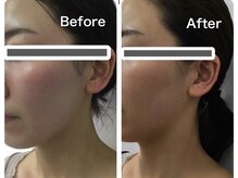 Hb 与野/小顔人気No.1 脂肪分解小顔