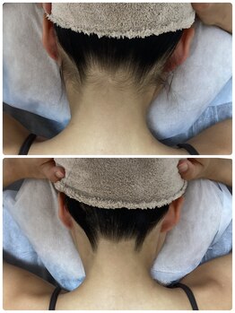 ルルトウキョウ 池袋店(LULU.tokyo)/うなじ脱毛