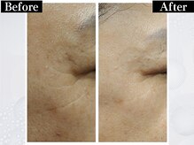 ポーベルポー(Peau Belle poe)/韓国美肌ララピール｜しみ・シワ