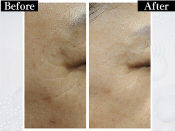 ポーベルポー(Peau Belle poe)/韓国美肌ララピール｜しみ・シワ