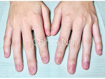 チヒロネイル/爪噛みによる深爪改善