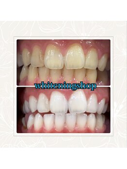 ホワイトニングショップ 奈良香芝店(Whitening shop)/セルフホワイトニング