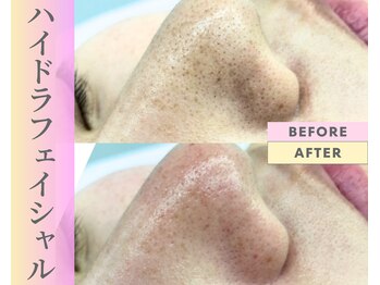 Cスキンケアクリニック 麻布店/毛穴洗浄ハイドラフェイシャル