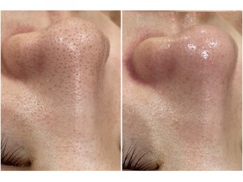 リッツ 草加店(Ritz)/【Before/After】毛穴