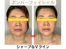 コトハ(cottha)/1回施術後
