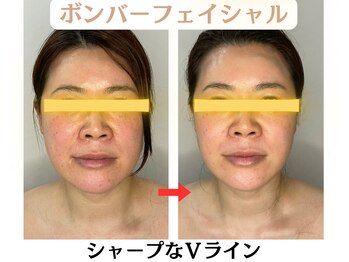 コトハ(cottha)/1回施術後