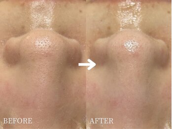 エース(ACE.)/鼻の黒ずみ、ザラザラ改善!