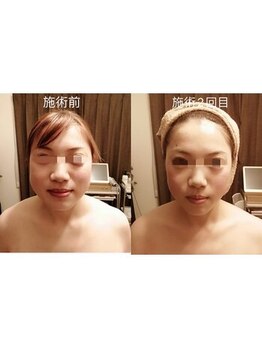 アンジュ/ウルトラリフト/たるみケア小顔