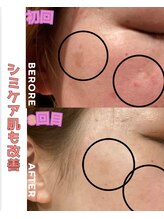 パルティノ 高崎店/シミケア