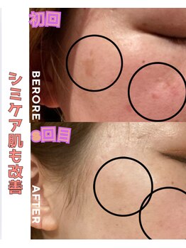 パルティノ 高崎店/シミケア