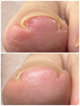 あし処 トコトコ(tocotoco)/巻き爪