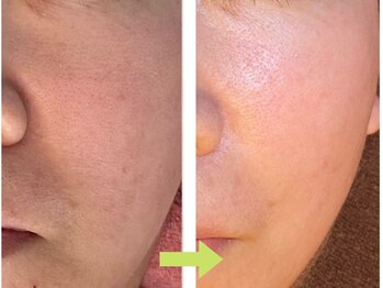 ソワン/ニキビ/毛穴の開き/小じわ