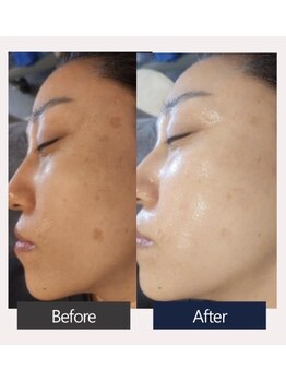 エスビーエス オキナワ(SBS OKINAWA)/第5世代ダクトピールモニター様