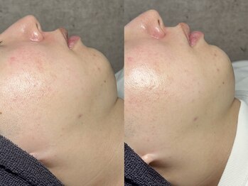 エモーショナル 姫路(Emotional)/ララピール×LDM【毛穴/艶肌】