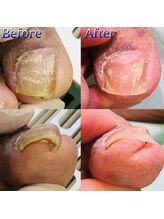 巻き爪補正店 湘南辻堂店/巻き爪・施術例