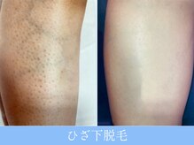 オーシャンブルー 大分店(OCEAN BLUE)/ひざ下脱毛